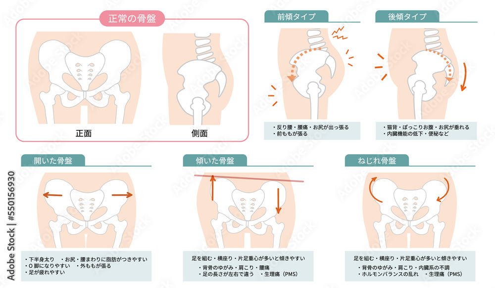 正常な骨盤の位置と歪んだ状態を表したイラスト 正常な骨盤の位置と歪んだ状態を表したイラスト