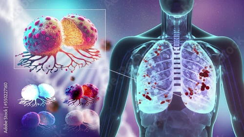 Lung Cancer concept with human body X-ray revealing lungs and cancer cells with DNA background 3d rendering