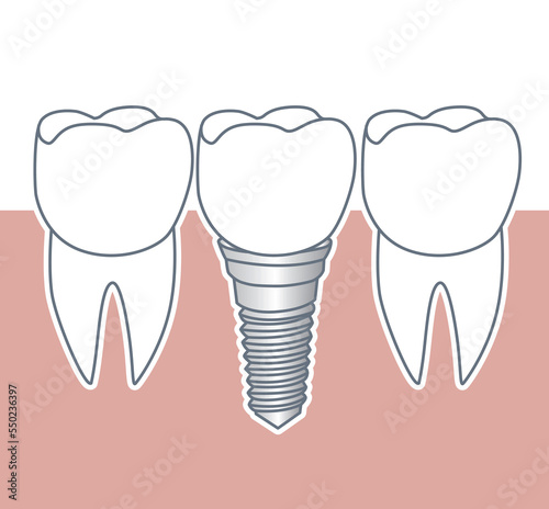 Dental implant screw and abutment for human healthy root, illustration on white background