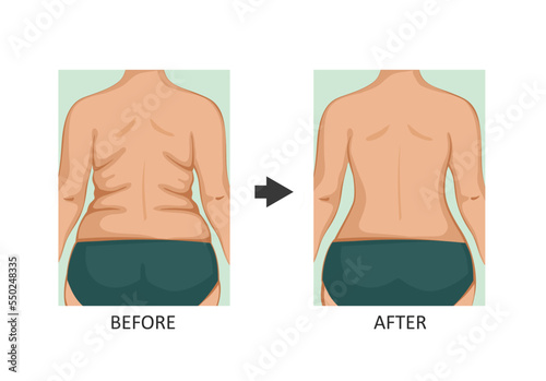 Back Lift. Back before and after diet, fitness or liposuction