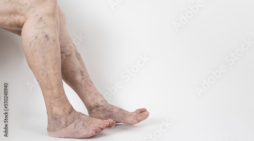Принти на полотні Painful varicose veins and spider veins on active women's legs, helping oneself to overcome pain