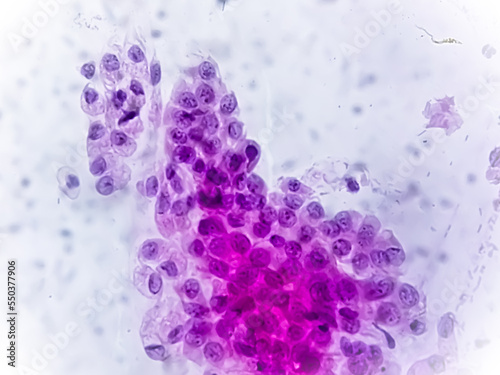 Microscopic view of Trichomonas vaginalis in pap smear with few acute inflammatory cells. Cytology and pathology laboratory department. Sexually transmitted disease. Trichomoniasis photo