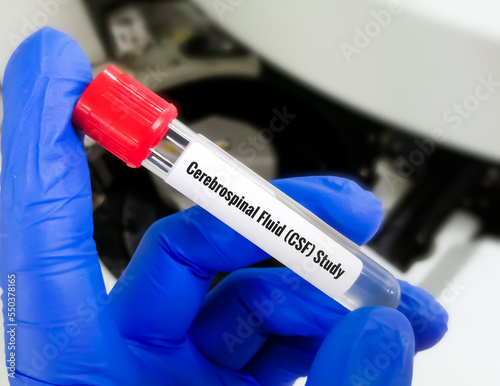 Cerebrospinal fluid (CSF) study including biochemistry, cytology, Gram staining. photo