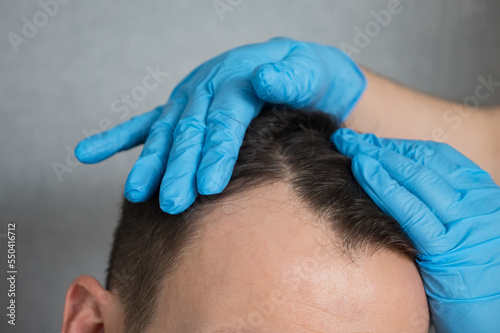 Hands of doctor in rubber gloves doing checkup of hair of man to fight male-pattern baldness. Patient gets prepared for hair transplant surgery,close-up