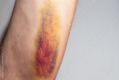 A large colored bruise on the skin of the inside of a man's shoulder. Medical concept photo