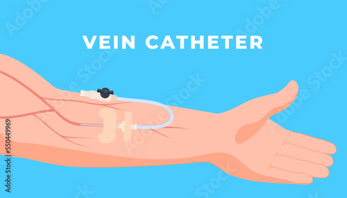 Venous Medical sterile catheters for patient treatment. Medical tools for accessing blood vessels and internal organs. Vector illustration