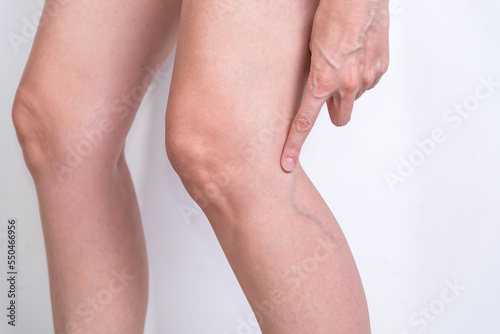 woman indicating varicose veins  veins  poor circulation