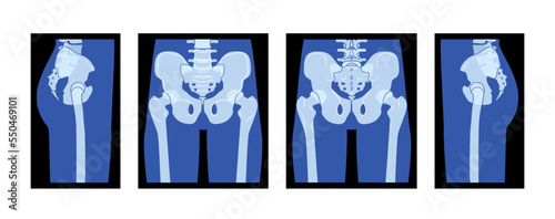 Set of X-Ray Pelvis and Femur Skeleton Hip Human body Bones adult people roentgen front back side view. 3D realistic flat blue color concept Vector illustration of medical anatomy isolated on black