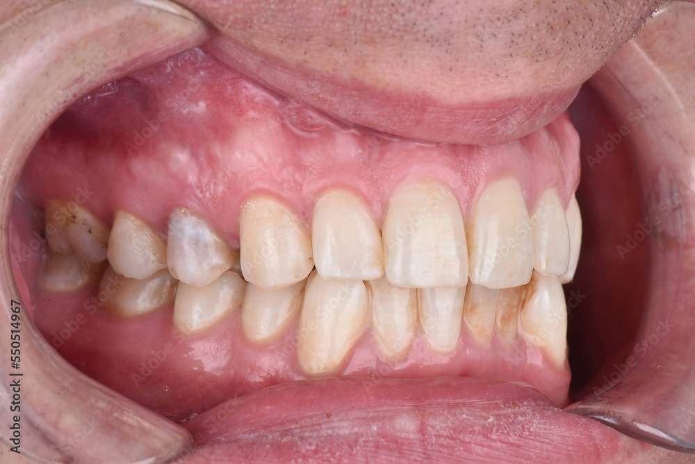 Close up side view teeth picture fixator dental examination before treatment