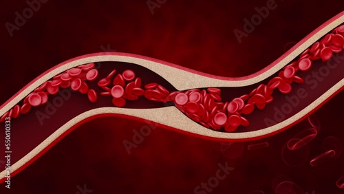 The formation of cholesterol plaques on the walls of blood vessels. 3d visualization of atherosclerosis. Medical concept.