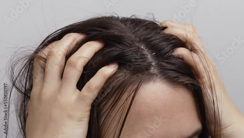 Woman scratching her head with dandruff photo