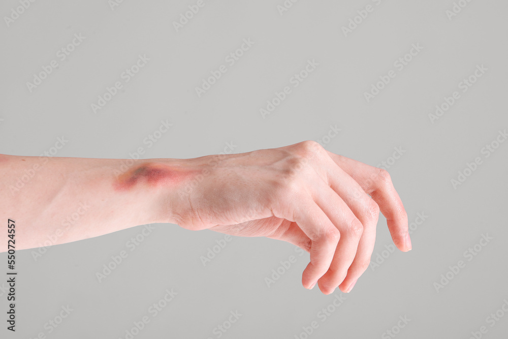 Bruised female hand on grey background