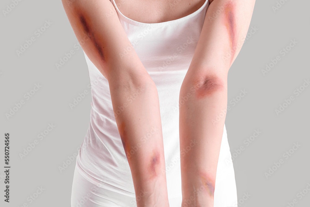 Young woman with bruised arms on grey background, closeup