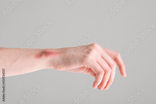 Bruised female hand on grey background