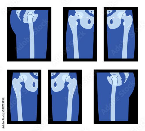 Set of X-Ray Hip and Leg, Head of the femur, Skeleton Human body Bones adult people roentgen front back side view. 3D realistic flat blue color concept Vector illustration of medical anatomy isolated
