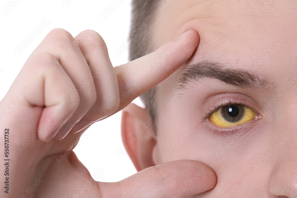 Man checking his health condition on white background, closeup. Yellow eyes as symptom of hepatitis
