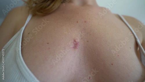 A wound that heals and turns into a scar after removing a cyst on a woman's breast.
A wound on chest. crusty scab. photo