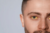 Man with yellow eyes on light grey background, closeup and space for text. Hepatitis symptom