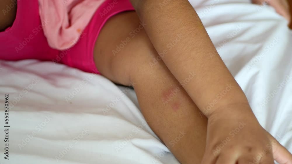 child girl suffering from itching skin, close up. child girl suffering from itching skin, close up.