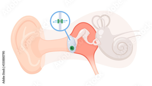 鼓膜チューブを挿入した耳と鼓膜の断面のイラスト_中耳炎 photo