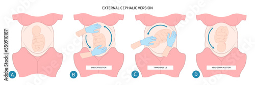 birth defect of Baby Labor C section praevia Mother twins cord hip lie bone fetal born Head Down canal Left womb Right spine pelvis cervix score Breech vertex Exam uterus Frank Bishop weeks Infant photo