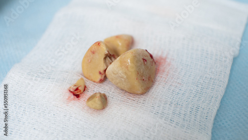 On a white napkin are stones from the bladder removed by the operation of cystolithotomy. The formation of stones in the bladder is called urolithiasis. photo
