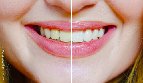 close-up. a woman's smile with a comparison of whitened and yellowish teeth. 