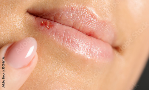herpes on the lips, part of a woman's face with her finger on her lips with herpes, beauty concept, health