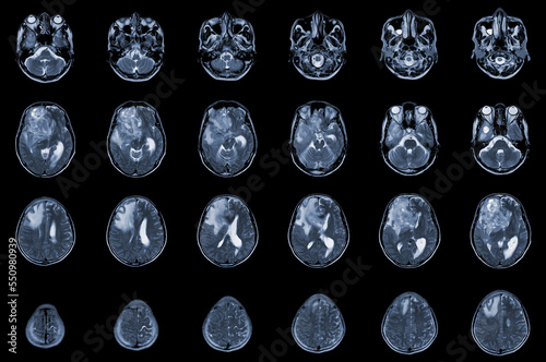 MRI Brain Axial views .to evaluate brain tumor. Glioblastoma, brain metastasis isodensity mass with an ill-defined margin and surrounding edema at the right frontal lobe.