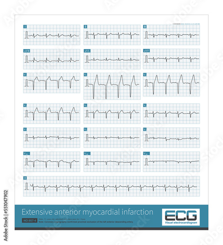 Fotografia A 31 year old male was clinically diagnosed as extensive anterior myocardial infarction