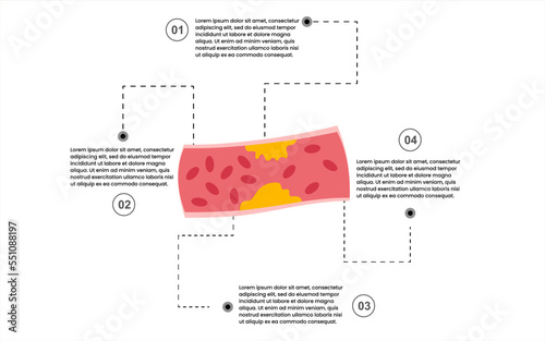Creative infographic template for sign to cholesterol blocked artery with 4 options vector illustration