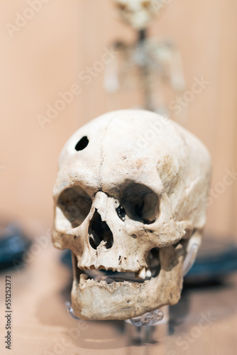 Human skull with hole in the head. Violence and lobotomy concept.