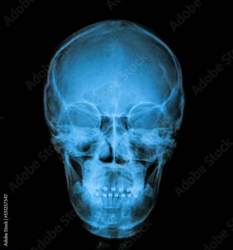 x ray image of skull