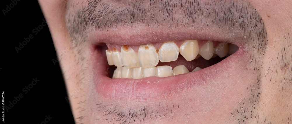 Obraz premium dental photography picture of dental treatment case