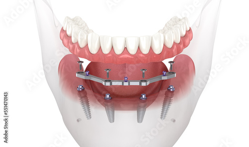 фотографія Mandibular prosthesis with gum All on 4 system supported by implants