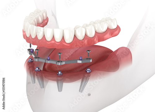 Mandibular prosthesis with gum All on 4 system supported by implants. Medically accurate 3D illustration