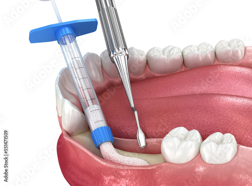 Bone grafting, augmentation. Medically accurate 3D illustration. photo