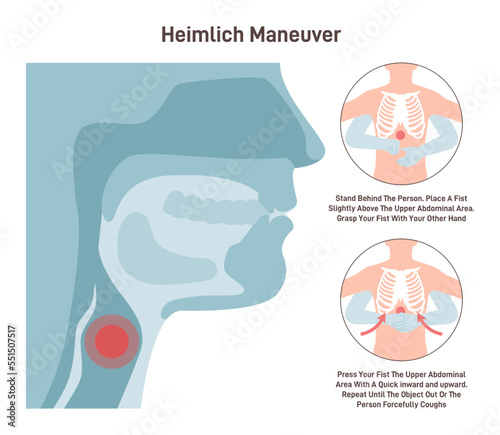 Choking first aid. Heimlich maneuver procedure to remove a foreign photo