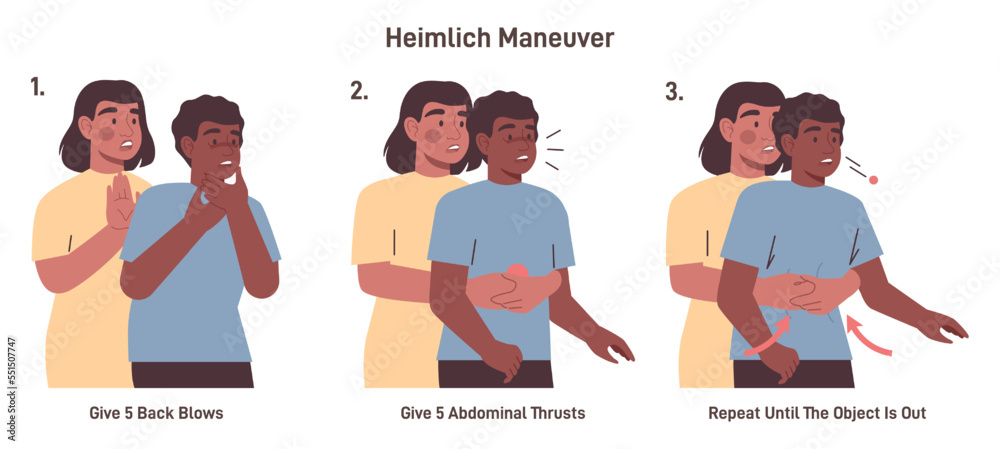 Heimlich Maneuver For Choking In Adults And Infants 53 OFF