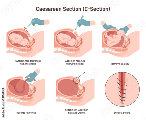 Stages of baby birth with caesarean section. Fetus position during