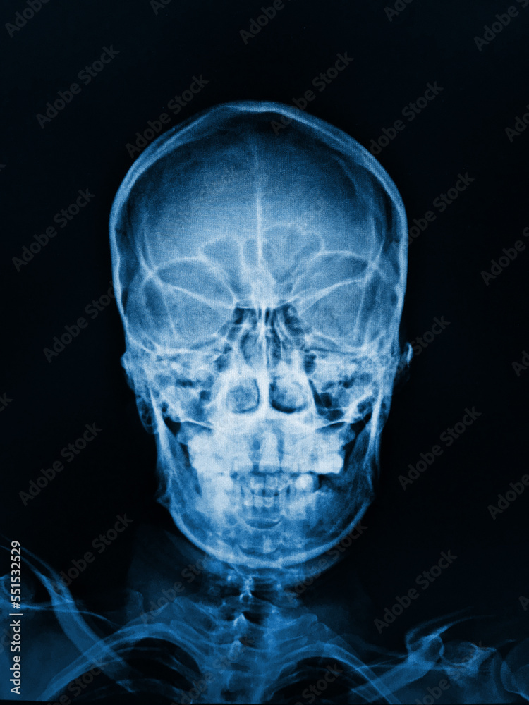 x ray of human skull x ray of human skull