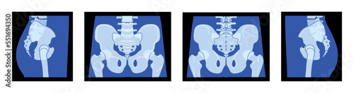 Set of X-Ray pelvis Skeleton Hip Human body Bones adult people roentgen front back side view. 3D realistic flat blue color concept Vector illustration of medical anatomy isolated on black background
