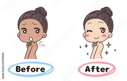 Illustration of a woman before and after sunburn.