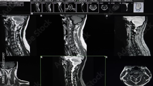 Cervical spine MRI scan of a patient with neck and shoulder pain showing disc bulging and spinal canal stenosis without cord compression. photo