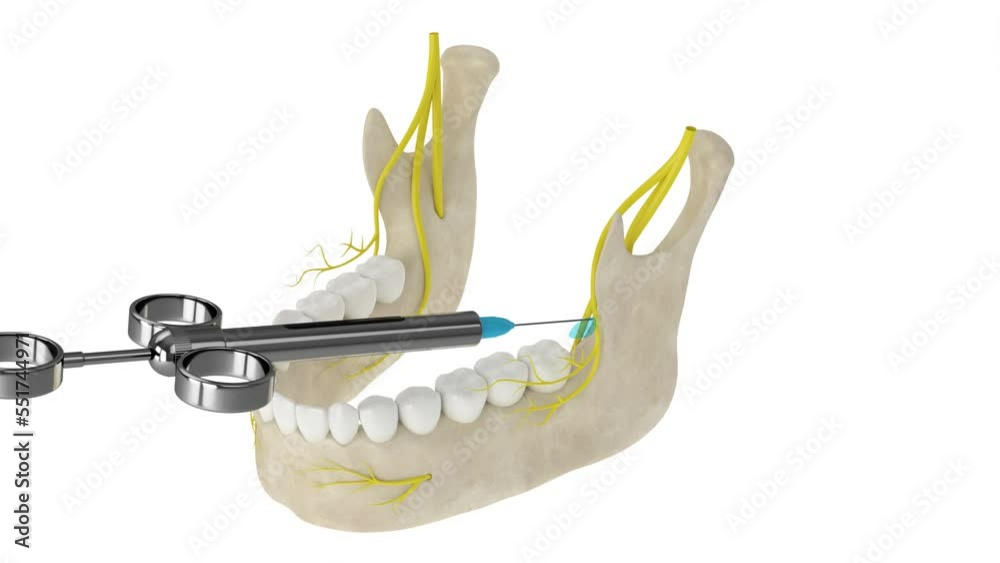 Mandibular arch with buccal nerve block. Types of dental anesthesia