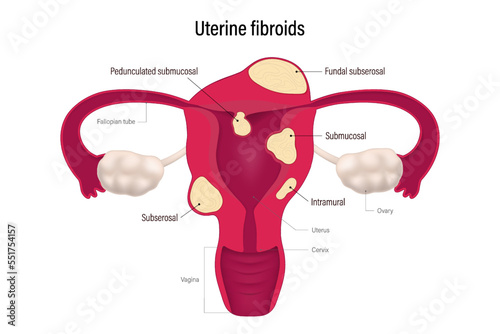 Uterine fibroid locations. Pedunculated submucosal, Fundal subserosal, Submucosal, Subserosal and Intramural. 