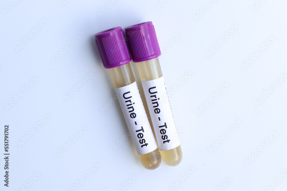 Urine test to look for abnormalities from Urine, Urine sample to
