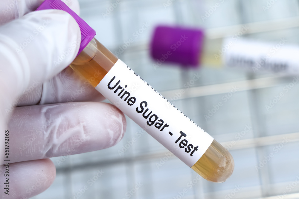 Fototapeta premium Urine Sugar test to look for abnormalities from Urine, Urine sample to analyze in the laboratory