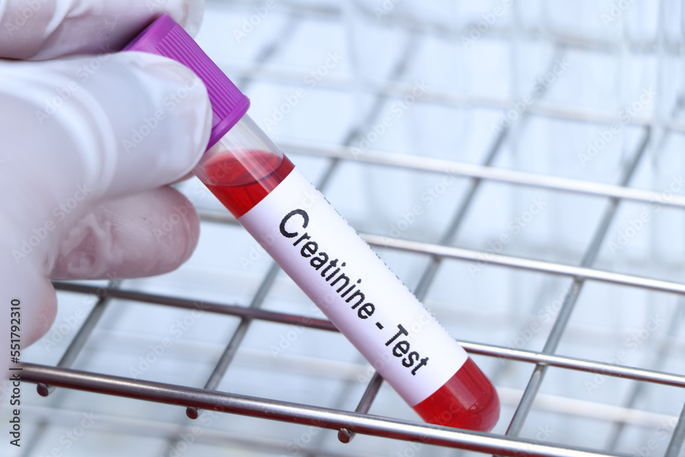 creatinine test to look for abnormalities from blood, blood sample to