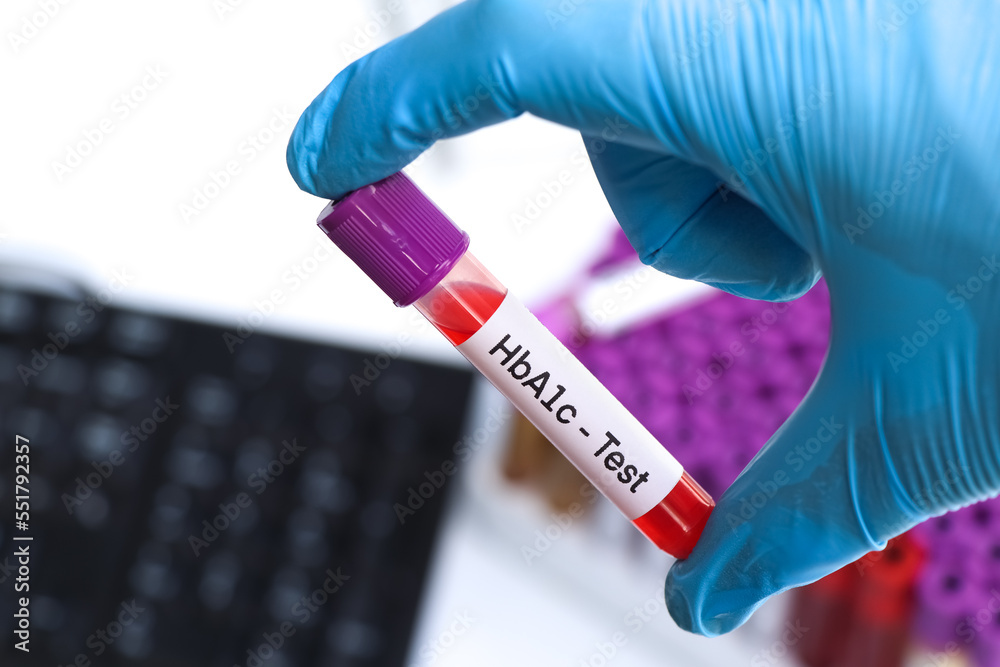 HbA1c test from blood , Blood samples to be analyzed in the laboratory